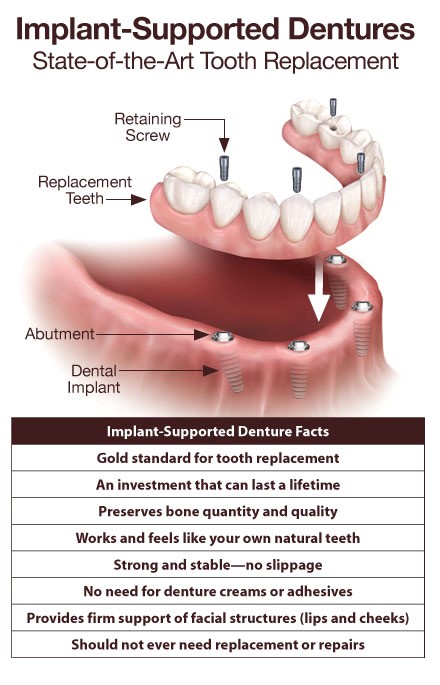 No More 
      Dentures Sedalia NC 27342